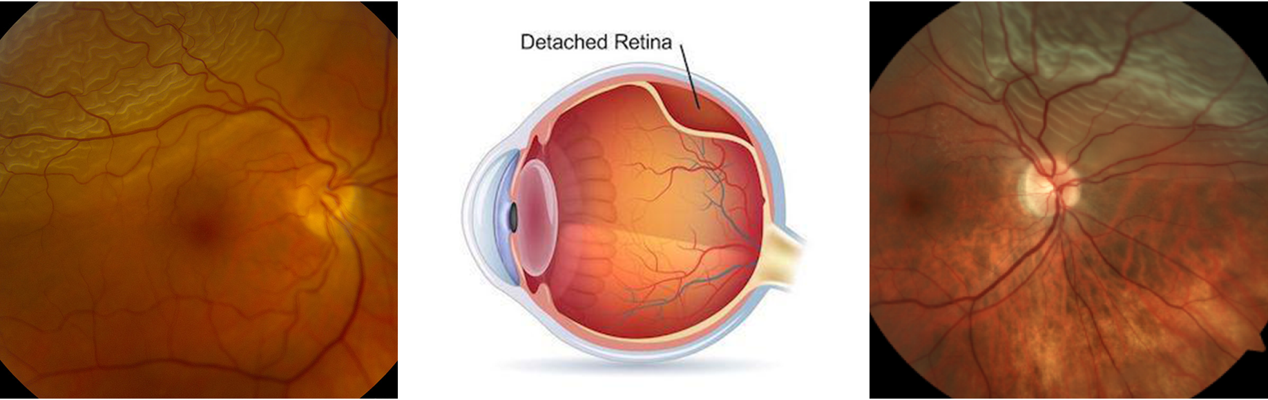 photo - retinal detachment